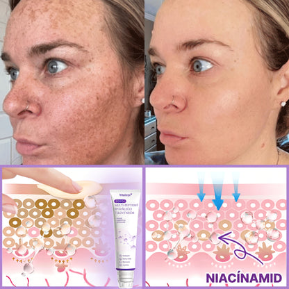 🇸🇰 Odporúčané dermatológmi🥇 | 🍍Vitalisys® PDRN multipeptidový masážny telový krém – Proti starnutiu, hydratačný, spevňujúci, regeneračný, zjednocujúci, na odstraňovanie akné a škvŕn, odstraňovanie bradavíc a materských znamienok, zmiernenie psoriázy.❤️