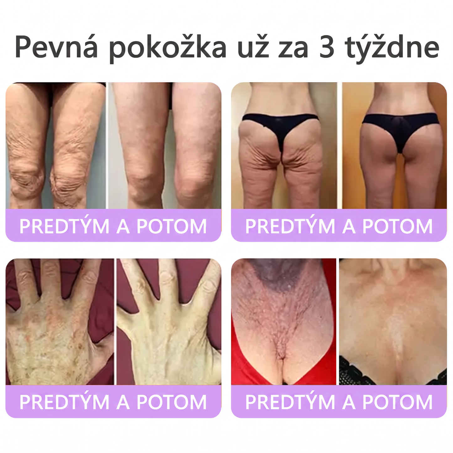 🇸🇰 Odporúčané dermatológmi🥇 | 🍍Vitalisys® PDRN multipeptidový masážny telový krém – Proti starnutiu, hydratačný, spevňujúci, regeneračný, zjednocujúci, na odstraňovanie akné a škvŕn, odstraňovanie bradavíc a materských znamienok, zmiernenie psoriázy.❤️