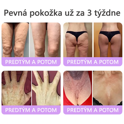 🇸🇰 Odporúčané dermatológmi🥇 | 🍍Vitalisys® PDRN multipeptidový masážny telový krém – Proti starnutiu, hydratačný, spevňujúci, regeneračný, zjednocujúci, na odstraňovanie akné a škvŕn, odstraňovanie bradavíc a materských znamienok, zmiernenie psoriázy.❤️