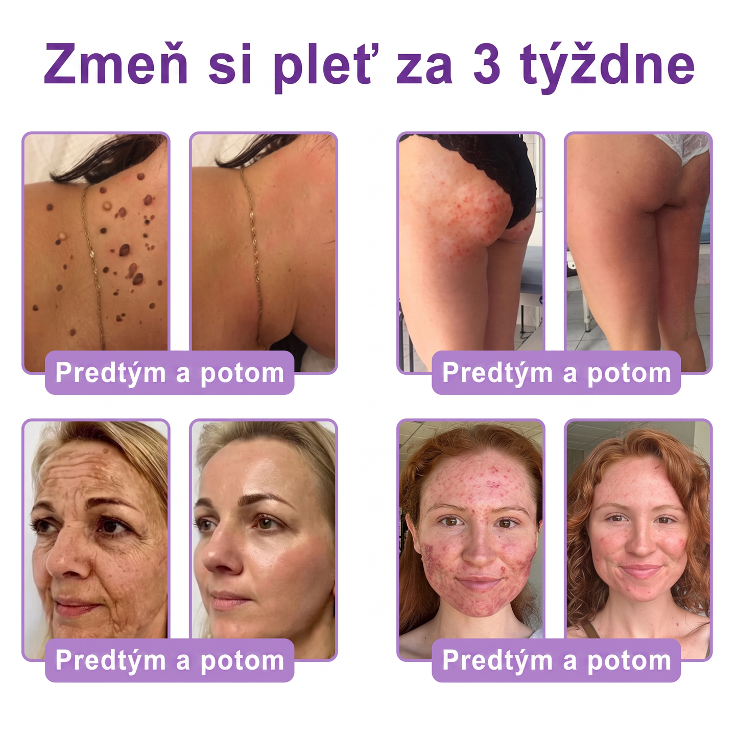 🇸🇰 Odporúčané dermatológmi🥇 | 🍍Vitalisys® PDRN multipeptidový masážny telový krém – Proti starnutiu, hydratačný, spevňujúci, regeneračný, zjednocujúci, na odstraňovanie akné a škvŕn, odstraňovanie bradavíc a materských znamienok, zmiernenie psoriázy.❤️