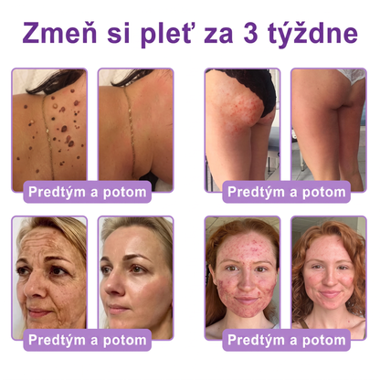 🇸🇰 Odporúčané dermatológmi🥇 | 🍍Vitalisys® PDRN multipeptidový masážny telový krém – Proti starnutiu, hydratačný, spevňujúci, regeneračný, zjednocujúci, na odstraňovanie akné a škvŕn, odstraňovanie bradavíc a materských znamienok, zmiernenie psoriázy.❤️