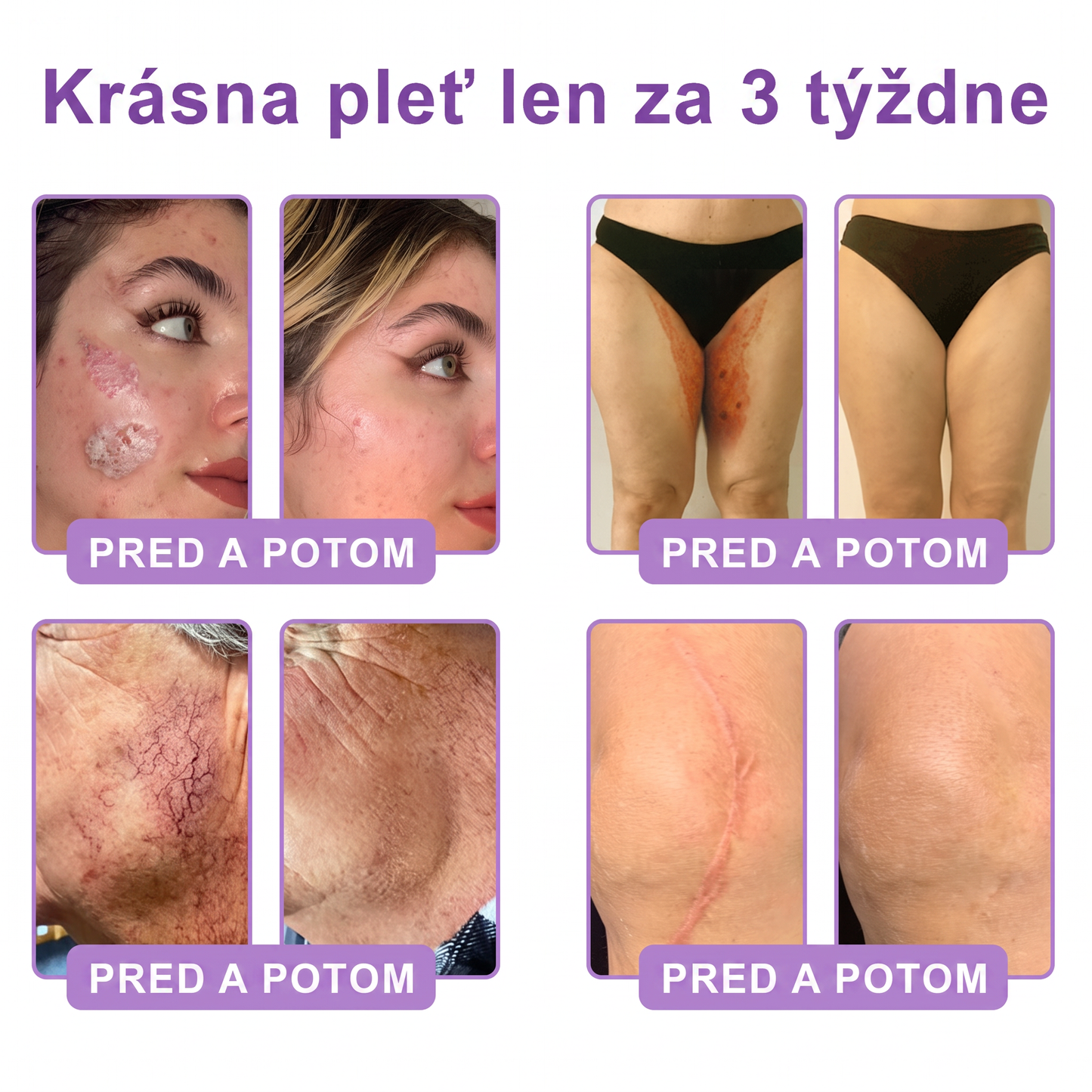 🇸🇰 Odporúčané dermatológmi🥇 | 🍍Vitalisys® PDRN multipeptidový masážny telový krém – Proti starnutiu, hydratačný, spevňujúci, regeneračný, zjednocujúci, na odstraňovanie akné a škvŕn, odstraňovanie bradavíc a materských znamienok, zmiernenie psoriázy.❤️