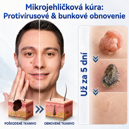 👩‍⚕️💯 Oficiálny obchod | MURWON® 🌥️ Mikroihličková náplasť na odstránenie kožných nedokonalostí (Na kožné výrastky, drobné kožné útvary, bradavice, materské znamienka, starecké škvrny a pigmentové nerovnosti.)❤️